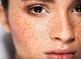 Как уменьшить пигментацию после лета